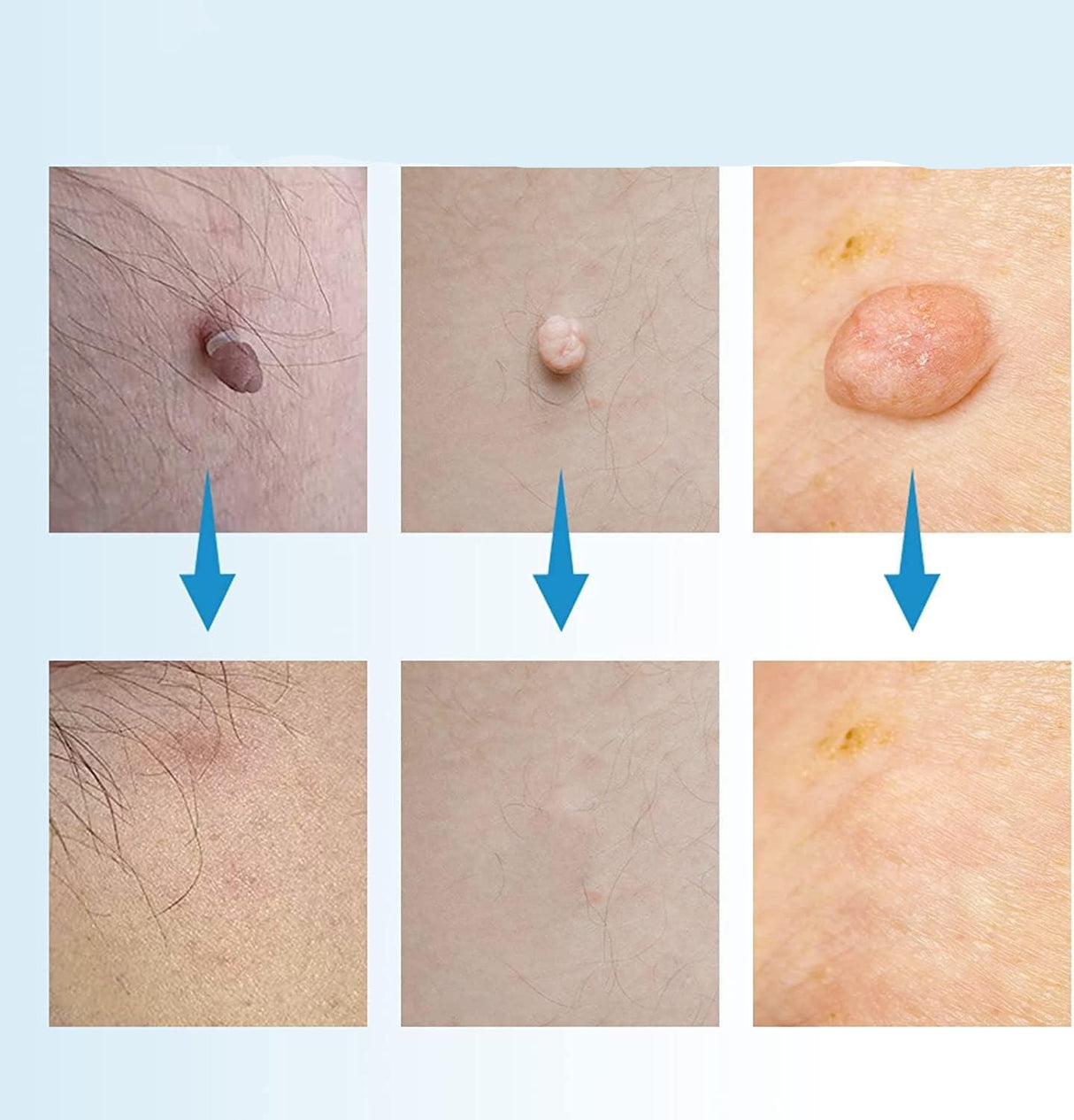 Skin Tag Removal Tool  Professional Home Treatment Kit - Detailed view