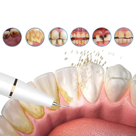 Ultrasonic Dental Plaque Remover  Professional Grade Tartar Cleaning Tool - Product showcase