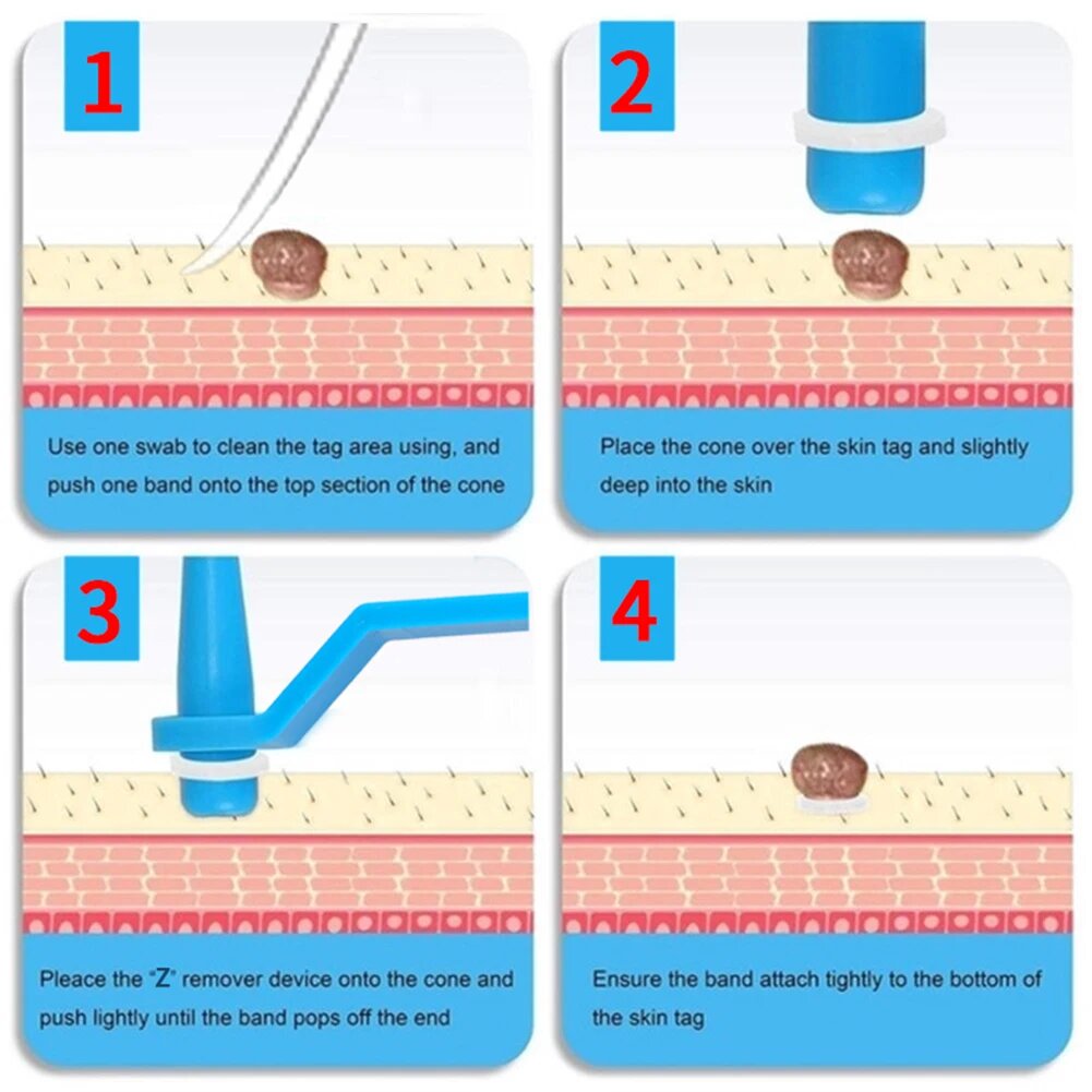 Professional Skin Tag Removal Kit  2-in-1 Silicone Ligation System - Product detail 5