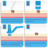 Professional Skin Tag Removal Kit  2-in-1 Silicone Ligation System - Product detail 5