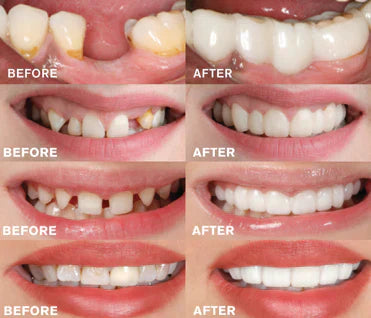 Dental Prosthesis Kit  Instant Fit Temporary Dentures - Product detail 5